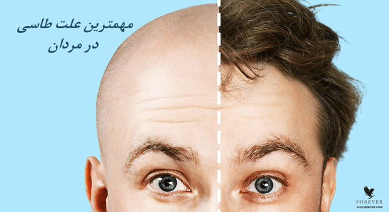 اگر ریزش مو را در مراحل اولیه شناسایی کنید. سریعتر درمان می شود