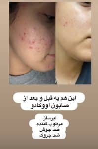 نتیجه و رضایت واقعی مشتری بعد از استفاده از صابون آووکادو فوراور