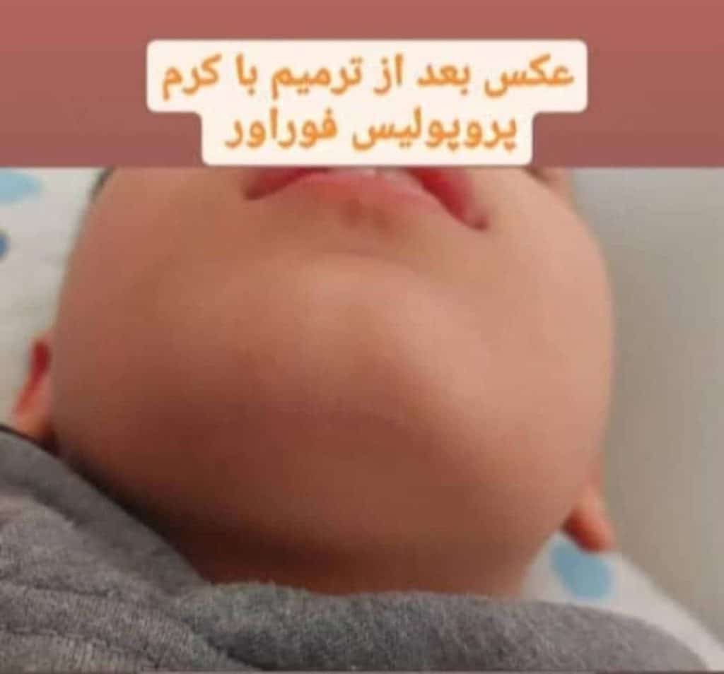 نتیجه و رضایت مشتری بعد از استفاده از کرم پروپولیس فوراور