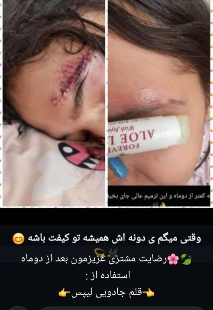 نتیجه واقعی و رضایت مشتری بعد از استفاده از لیپس فوراور برای از بین بردن جای زخم
